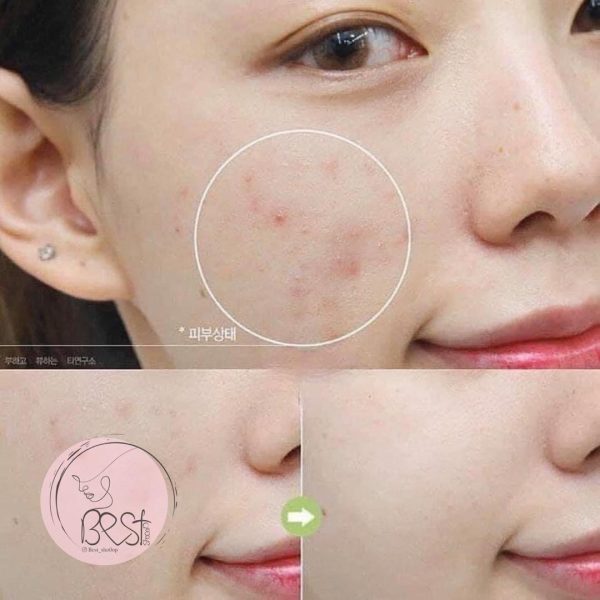 فوم شوینده رفع مشکلات پوستی بیجا برند اینسفری - Image 7